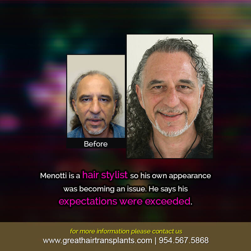 Menotti's Hair  Transplant Story Before And Afters Difficult Cases Hairline Short Videos 