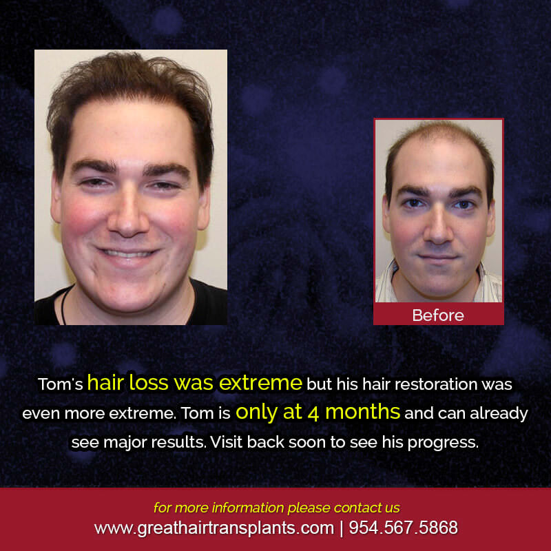 Tom's Hair  Transplant Story Before And Afters Difficult Cases Hairline Short Videos 