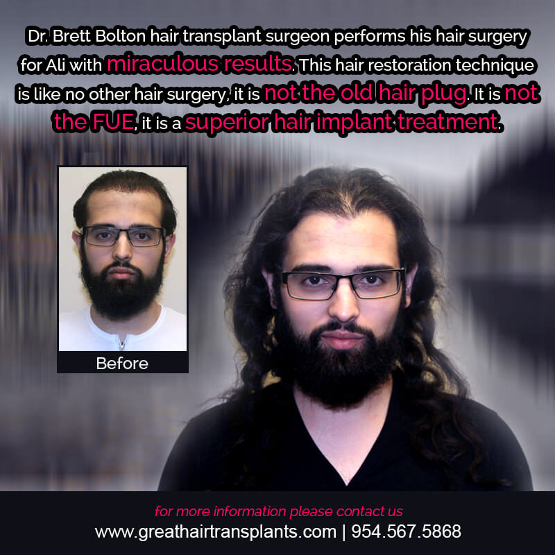 Ali's Hair Transplant Story Before And Afters Difficult Cases Hairline Short Videos