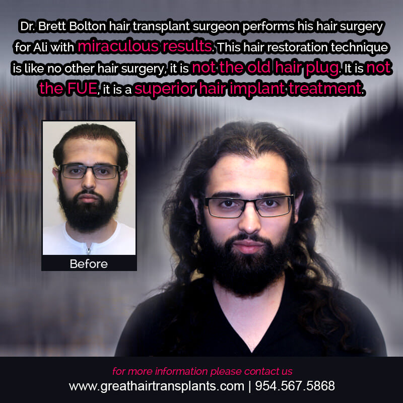 Ali's Hair  Transplant Story Before And Afters Difficult Cases Hairline Short Videos 