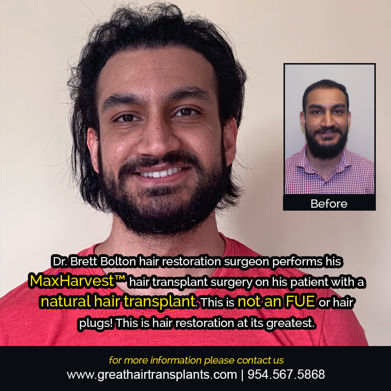 Mehtab's Hair Transplant Story Before And Afters Difficult Cases Hairline Short Videos