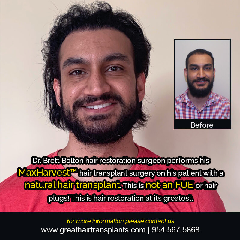 Mehtab's Hair  Transplant Story Before And Afters Difficult Cases Hairline Short Videos 