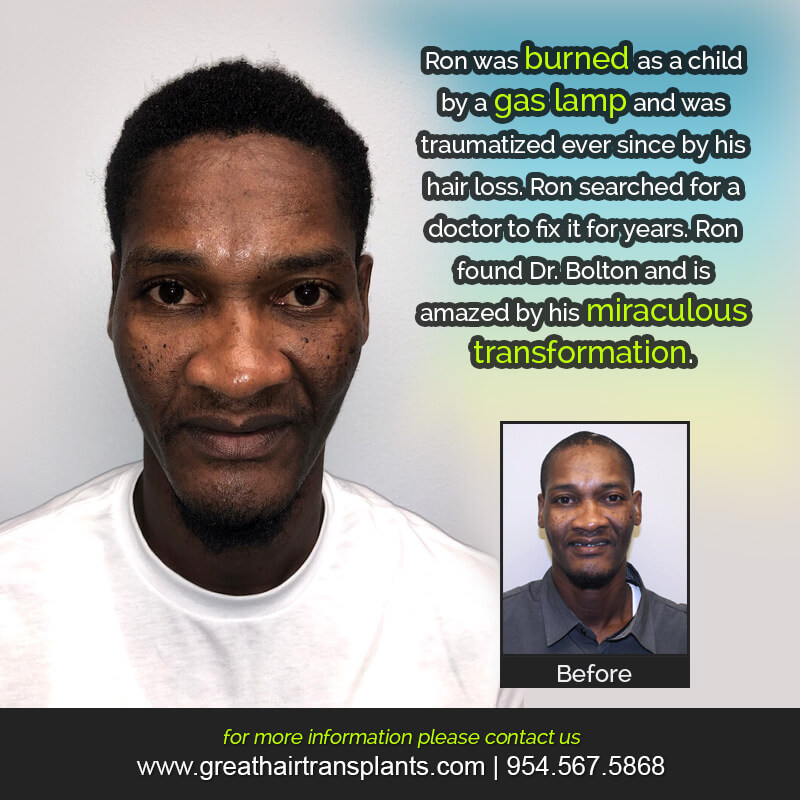 Ron's Hair Transplant Story Before And Afters Difficult Cases Hairline Short Videos