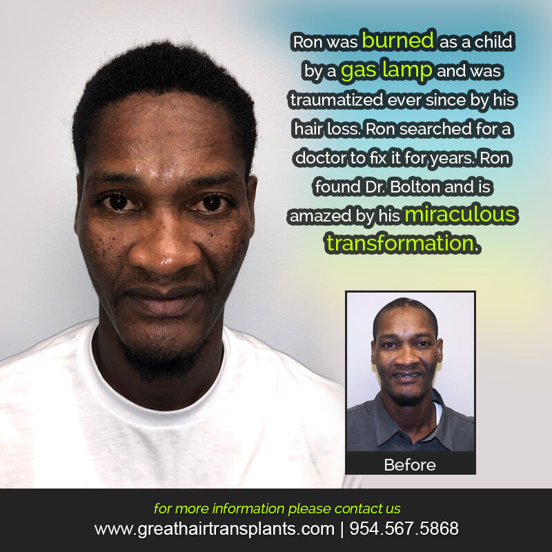 Ron's Hair  Transplant Story Before And Afters Difficult Cases Hairline Short Videos 