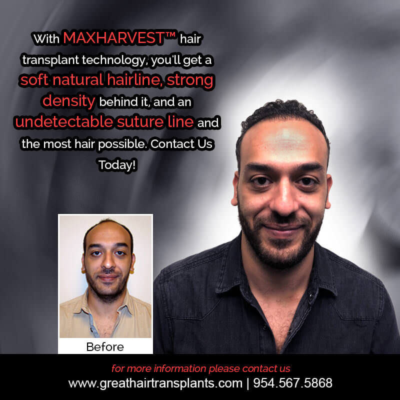 Karim's Hair Transplant Story Before And Afters Difficult Cases Hairline Short Videos