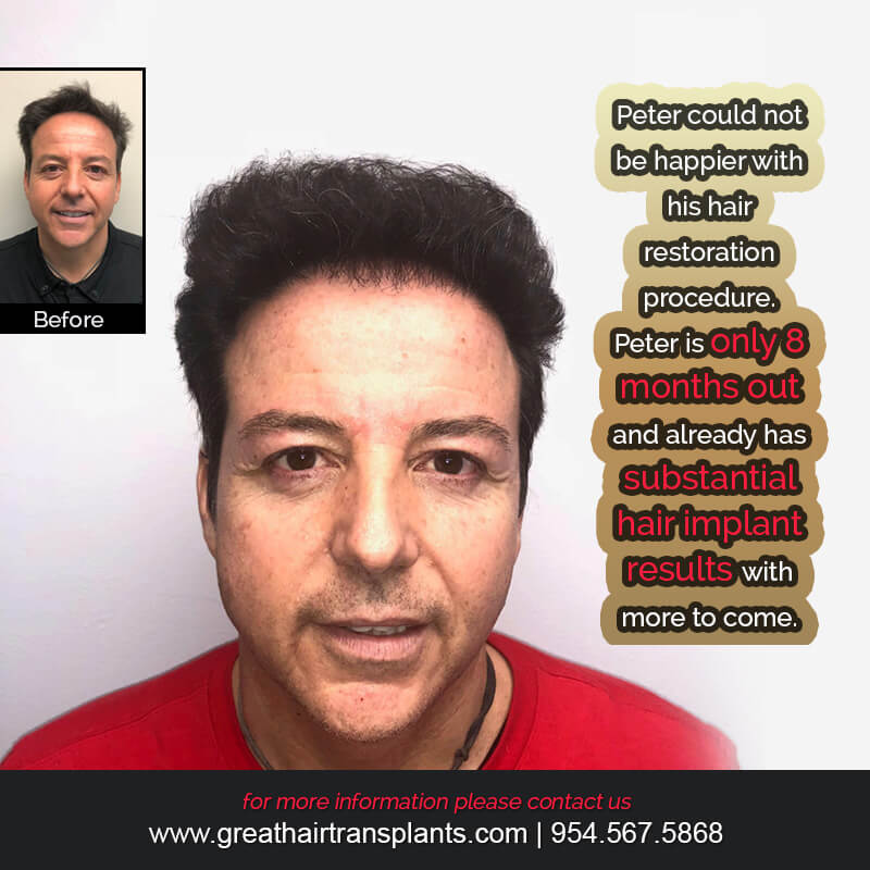 Peter's Hair  Transplant Story Before And Afters Difficult Cases Hairline Short Videos 