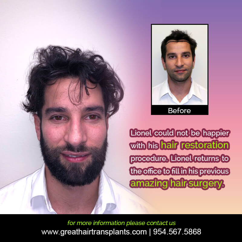 Lionel's Hair Transplant Story Before And Afters Difficult Cases Hairline Short Videos