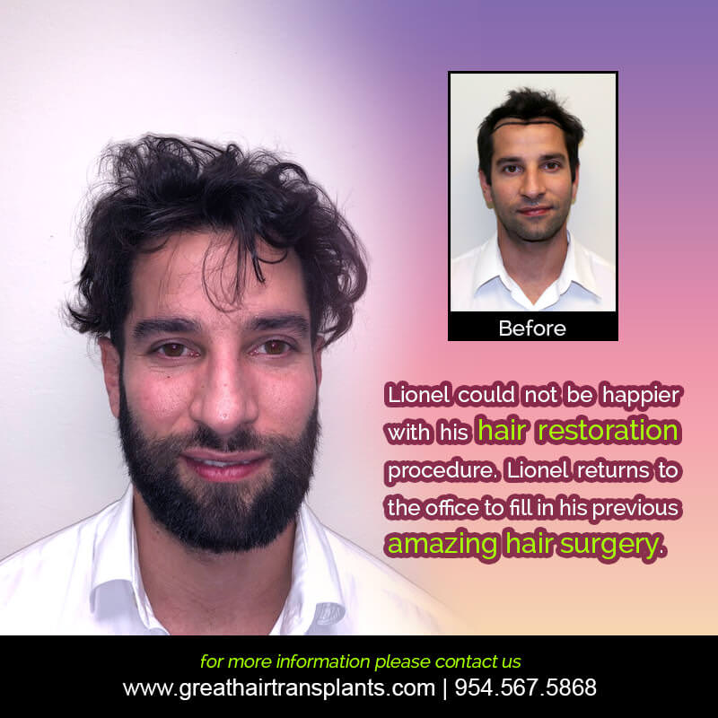 Lionel's Hair  Transplant Story Before And Afters Difficult Cases Hairline Short Videos 