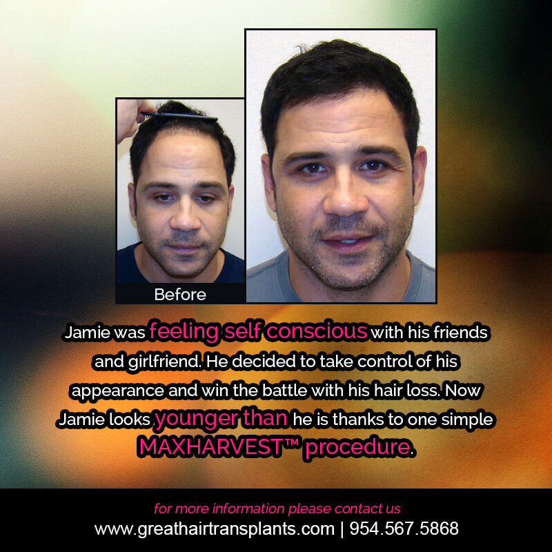 Jamie's Hair Transplant Story Before And Afters Difficult Cases Hairline Short Videos