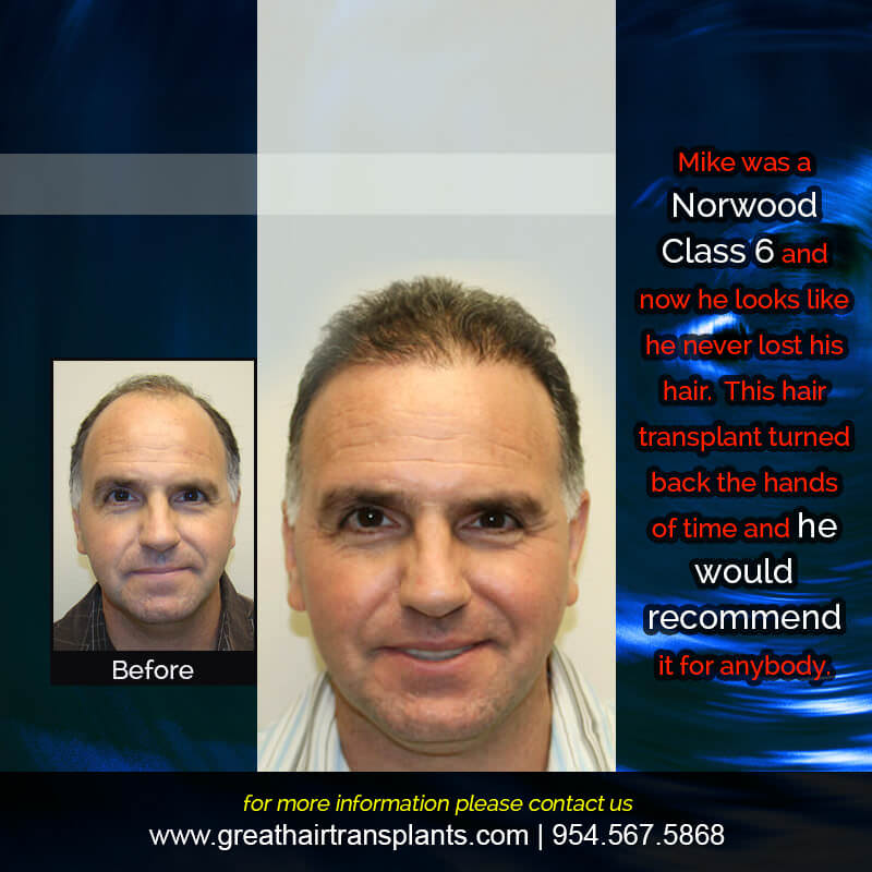 Mike's Hair  Transplant Story Before And Afters Difficult Cases Hairline Short Videos 