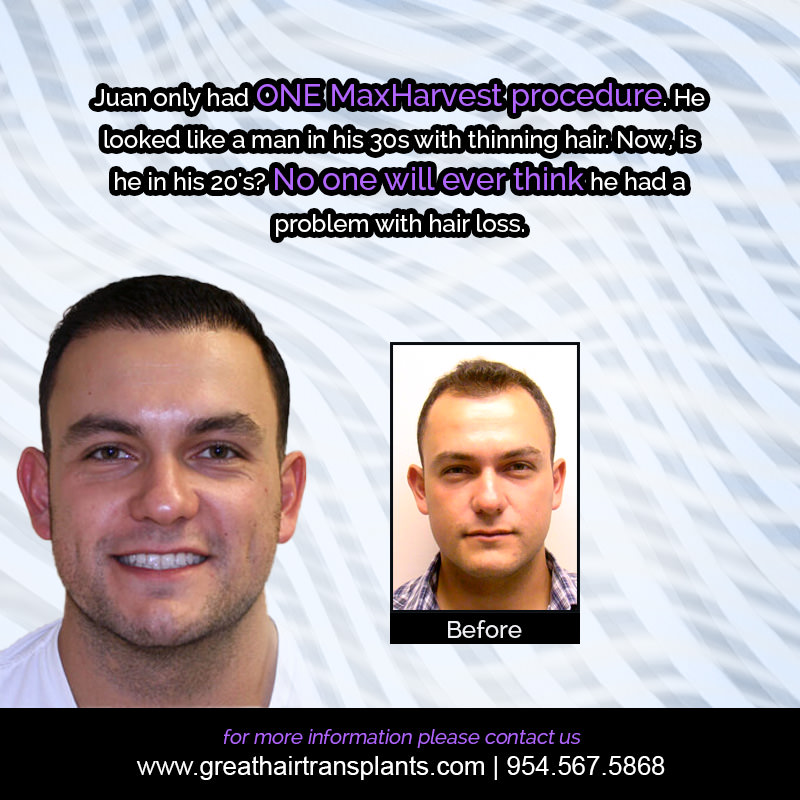 Juan's Hair  Transplant Story Before And Afters Difficult Cases Hairline Short Videos 