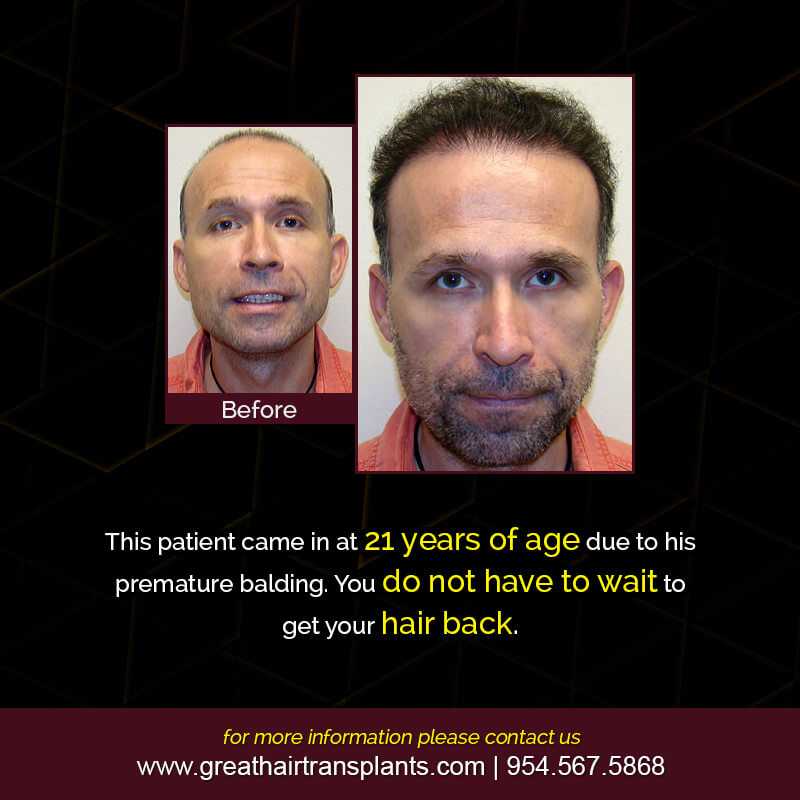Cameron's Hair  Transplant Story Before And Afters Difficult Cases Hairline Short Videos 