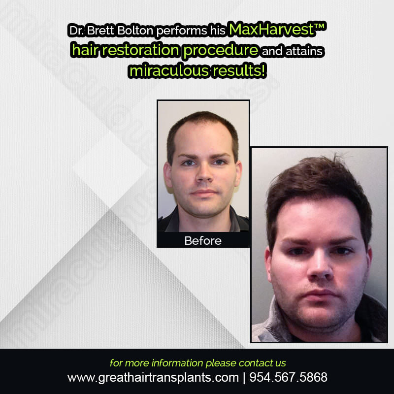 Eric's Hair  Transplant Story Before And Afters Difficult Cases Hairline Short Videos 