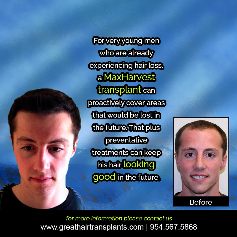 Ryan's Hair  Transplant Story Before And Afters Difficult Cases Hairline Short Videos 