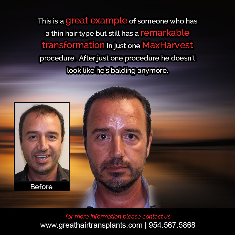Ali's Hair  Transplant Story Before And Afters Difficult Cases Hairline Short Videos 
