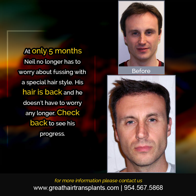 Dr. Brett Bolton's Hair  Transplant Patient Story Before And Afters Difficult Cases Hairline Short Videos 