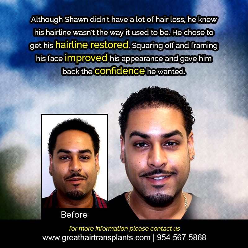 Shawn's Hair  Transplant Story Before And Afters Difficult Cases Hairline Short Videos 
