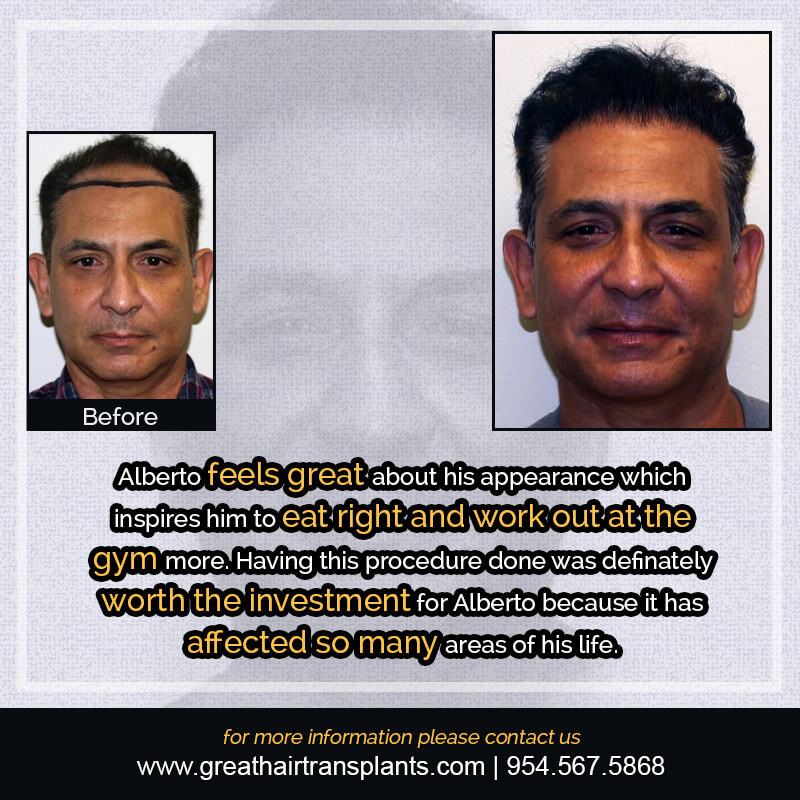 Alberto's Hair Transplant Story Before And Afters Difficult Cases Hairline Short Videos