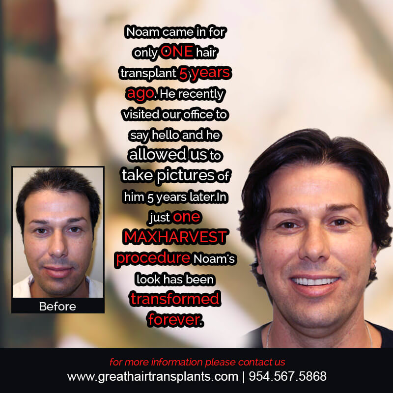 Noam's Hair  Transplant Story Before And Afters Difficult Cases Hairline Short Videos 