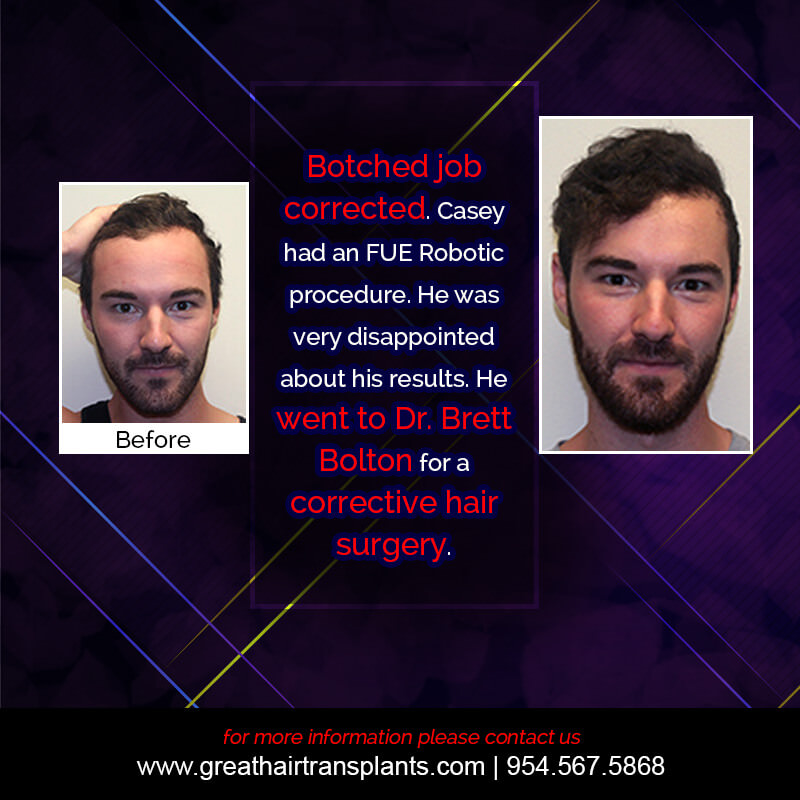 Casey's Hair  Transplant Story Before And Afters Difficult Cases Hairline Short Videos 