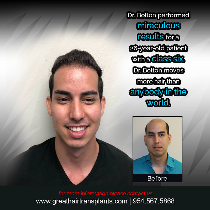 Aly's Hair  Transplant Story Before And Afters Difficult Cases Hairline Short Videos 