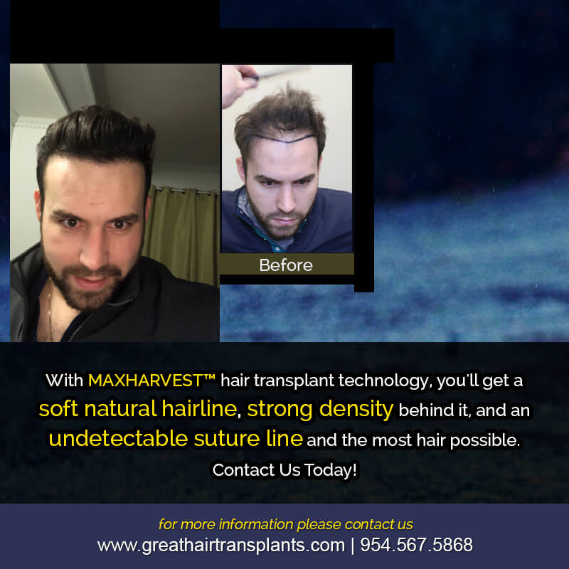 Martins's Hair Transplant Story Before And Afters Difficult Cases Hairline Short Videos