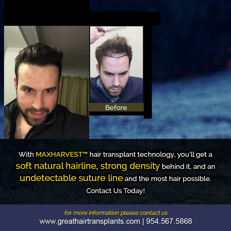 Martins's Hair  Transplant Story Before And Afters Difficult Cases Hairline Short Videos 