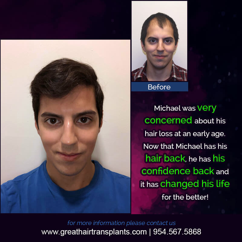 Michael's Hair  Transplant Story Before And Afters Difficult Cases Hairline Short Videos 