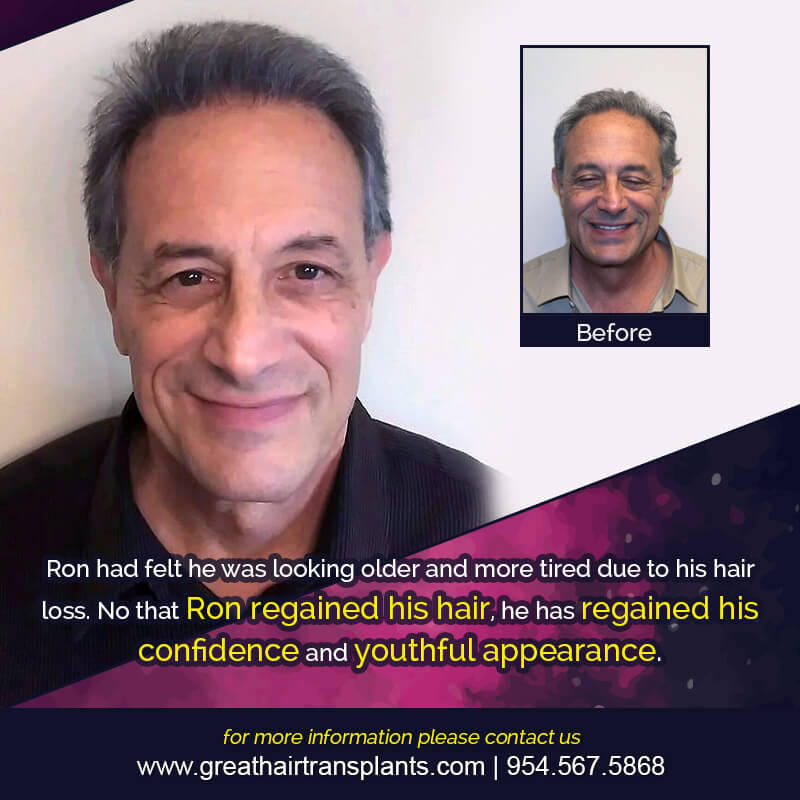 Ron's Hair  Transplant Story Before And Afters Difficult Cases Hairline Short Videos 
