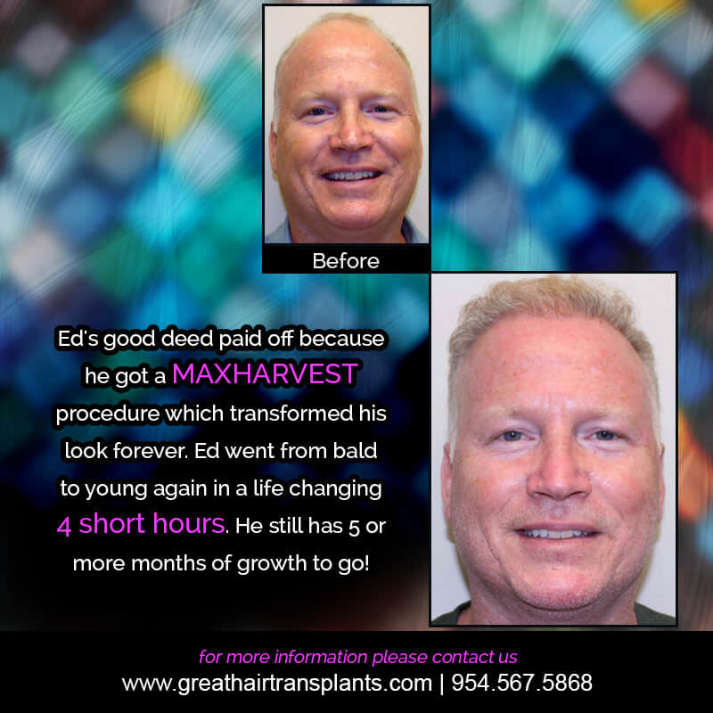 ED's Hair  Transplant Story Before And Afters Difficult Cases Hairline Short Videos 