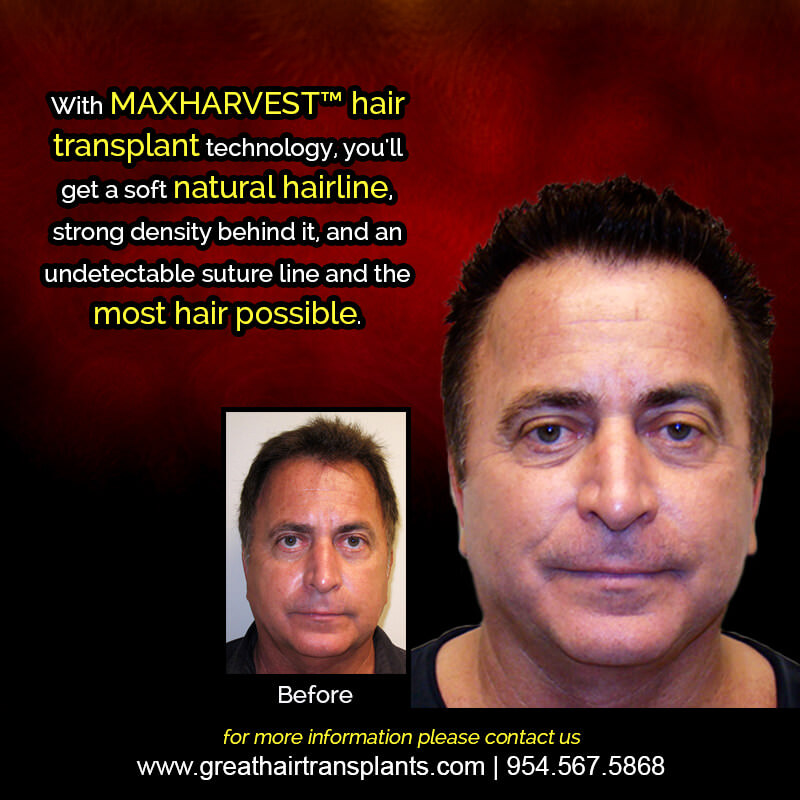 Dr Brett Bolton Patient's Hair Transplant Story Before And Afters Difficult Cases Hairline Short Videos