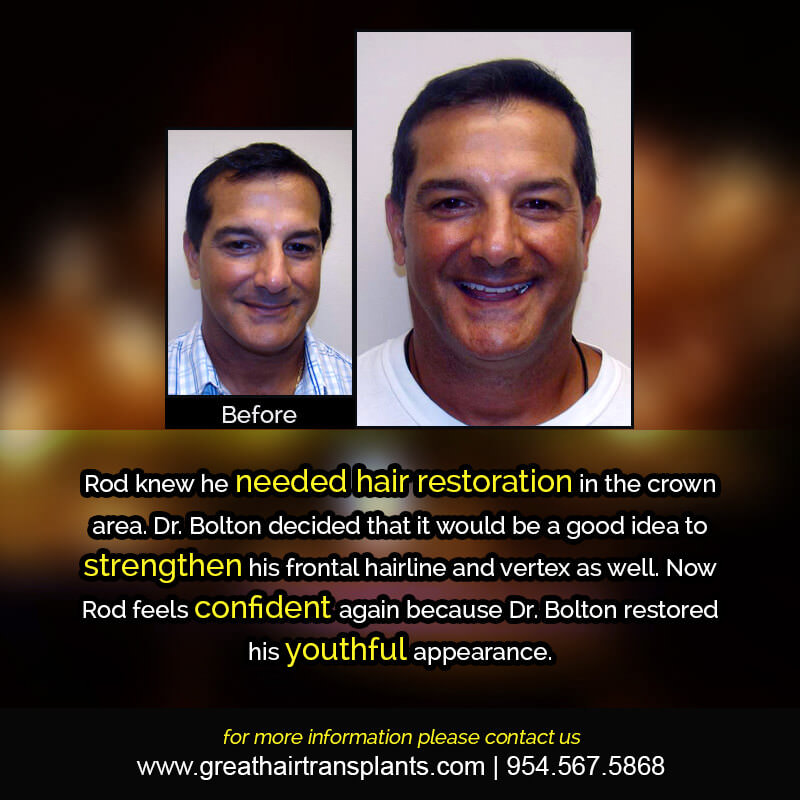 Rod's Hair  Transplant Story Before And Afters Difficult Cases Hairline Short Videos 