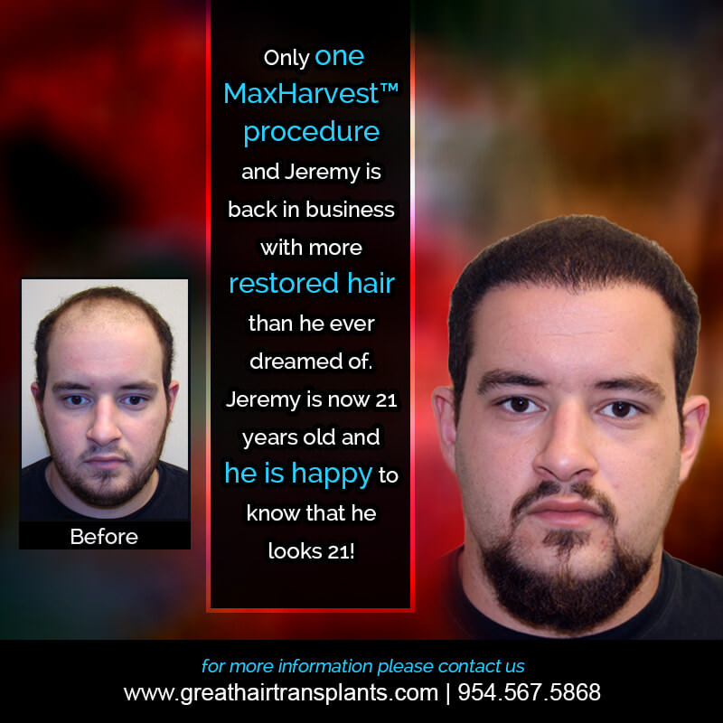 Jeremy's Hair  Transplant Story Before And Afters Difficult Cases Hairline Short Videos 