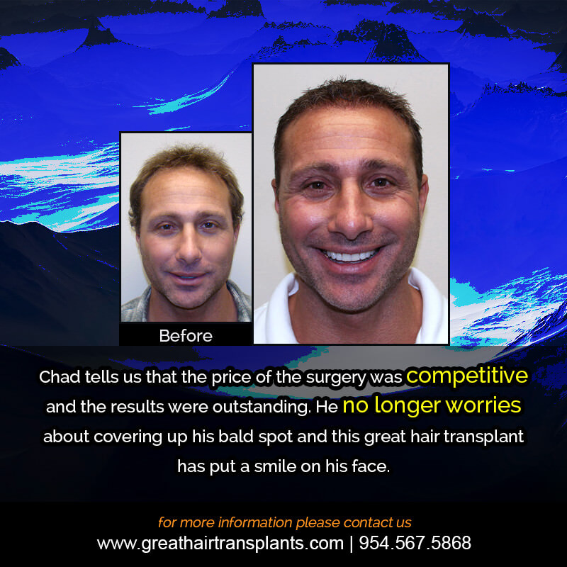 Chad's Hair  Transplant Story Before And Afters Difficult Cases Hairline Short Videos 
