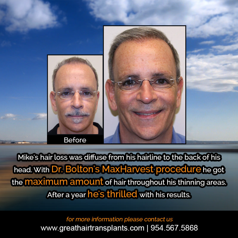 Mike's Hair  Transplant Story Before And Afters Difficult Cases Hairline Short Videos 