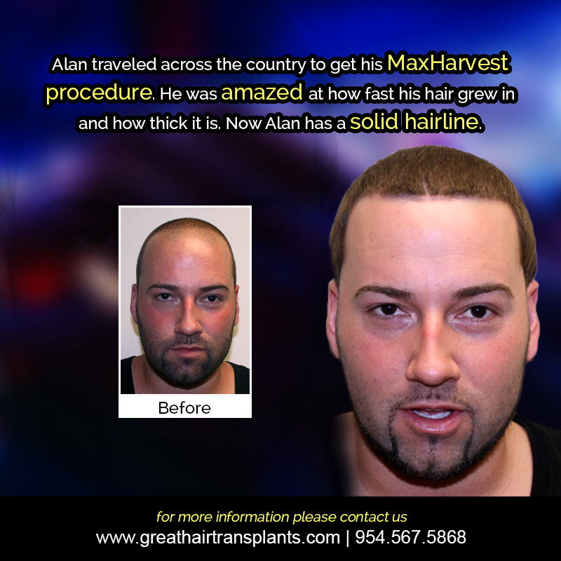 Alan's Hair  Transplant Story Before And Afters Difficult Cases Hairline Short Videos 