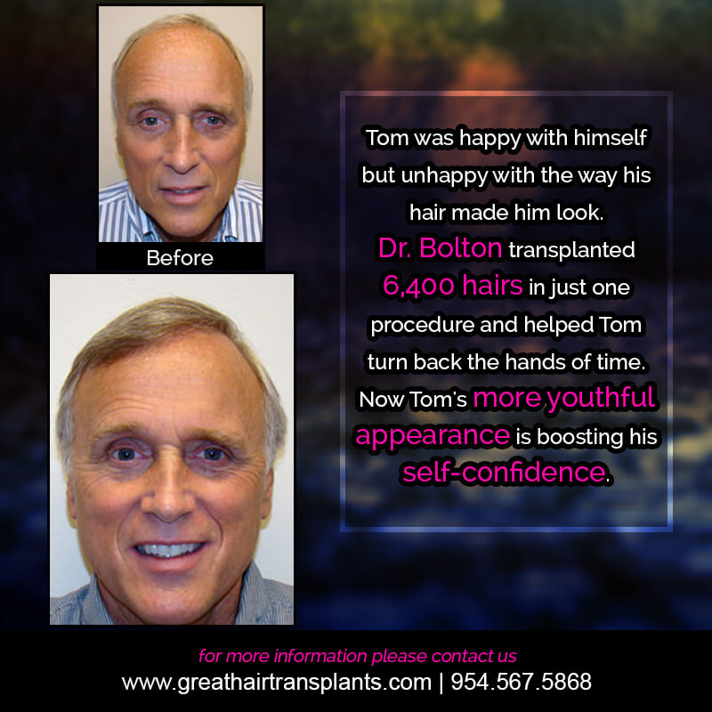 Tom Hair  Transplant Story Before And Afters Difficult Cases Hairline Short Videos 