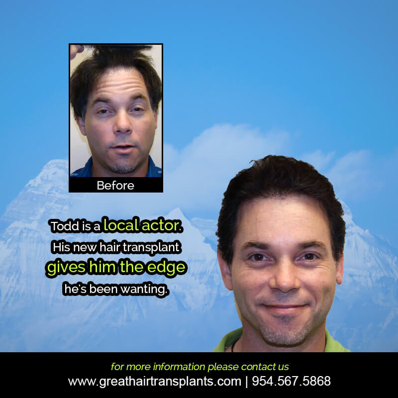 Todd's Hair  Transplant Story Before And Afters Difficult Cases Hairline Short Videos 