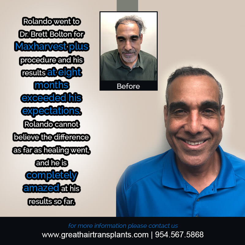 Rolando 's Hair  Transplant Story Before And Afters Difficult Cases Hairline Short Videos 
