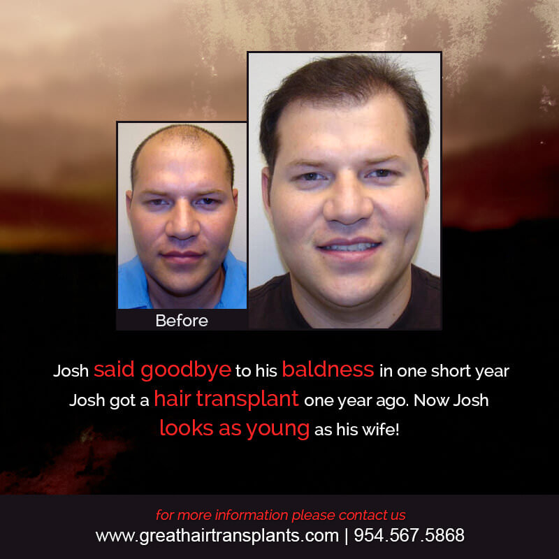 Josh's Hair  Transplant Story Before And Afters Difficult Cases Hairline Short Videos 