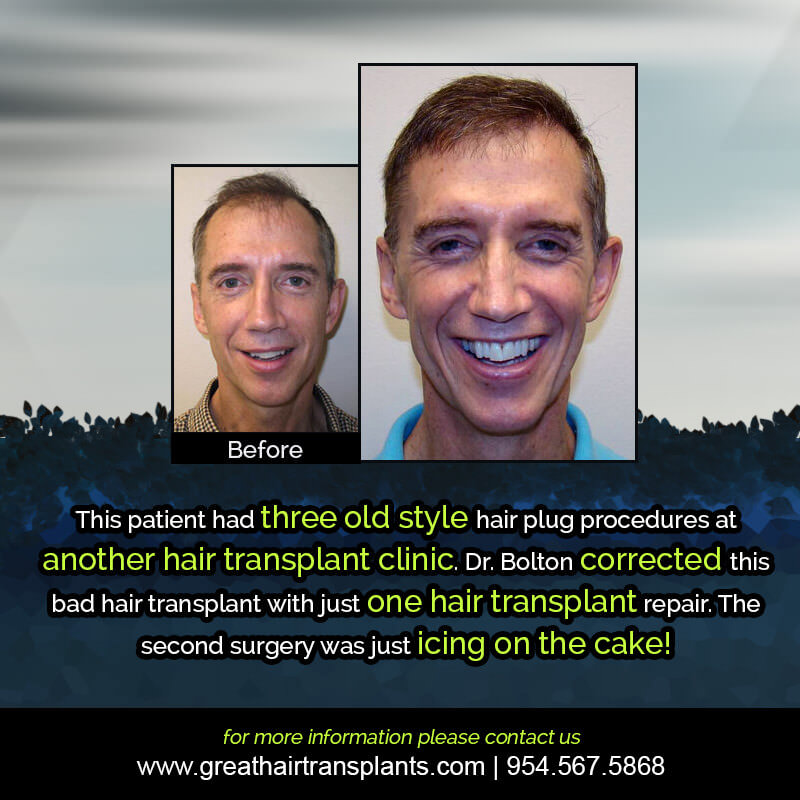 Gregs's Hair  Transplant Story Before And Afters Difficult Cases Hairline Short Videos 
