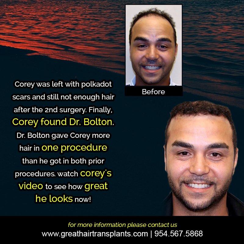 Corey's Hair  Transplant Story Before And Afters Difficult Cases Hairline Short Videos 