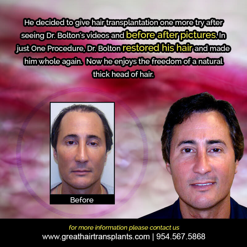 Hair Transplant Story Before And Afters Difficult Cases Hairline Short Videos