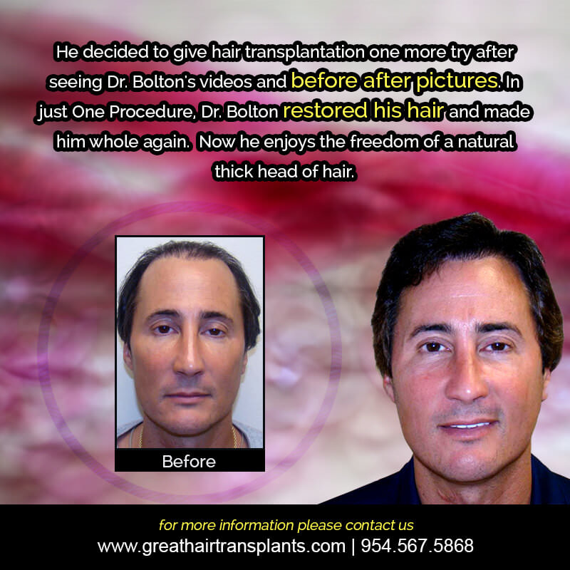 Hair  Transplant Story Before And Afters Difficult Cases Hairline Short Videos 