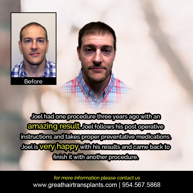 Joel's Hair  Transplant Story Before And Afters Difficult Cases Hairline Short Videos 