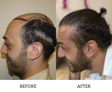 The Benefits of a Hair Transplant Are Long-Lasting and Can Change Your Life Before And Afters 