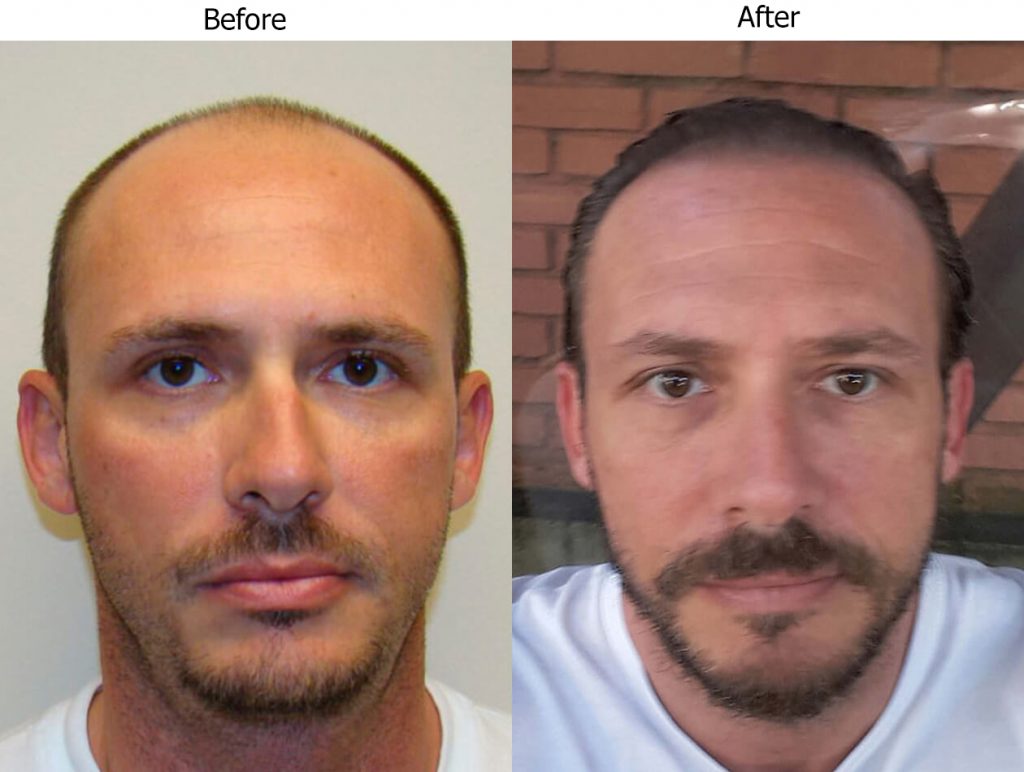 Life-Changing Hair Transplant Results Before And Afters Difficult Cases Hairline Healing/Growth Process 