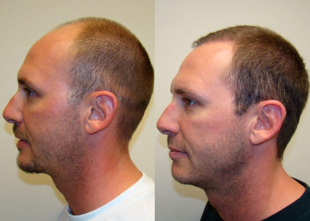 Life-Changing Hair Transplant Results Before And Afters Difficult Cases Hairline Healing/Growth Process 