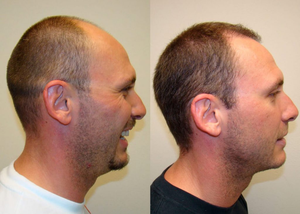 Life-Changing Hair Transplant Results Before And Afters Difficult Cases Hairline Healing/Growth Process 