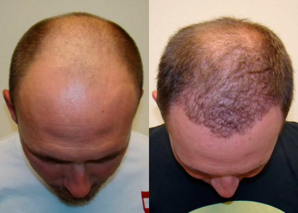 Life-Changing Hair Transplant Results Before And Afters Difficult Cases Hairline Healing/Growth Process 